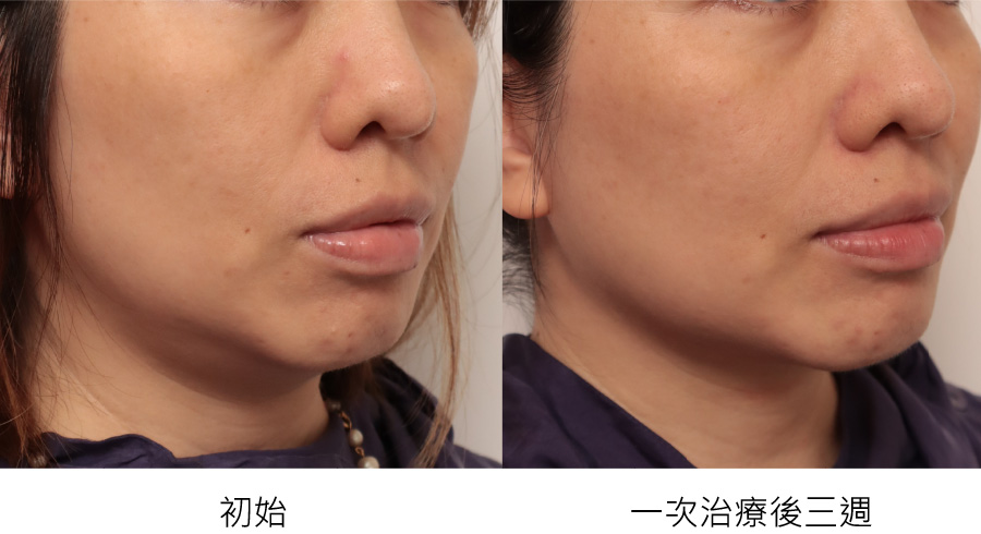 before_after