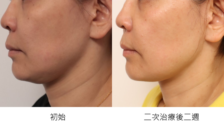 before_after