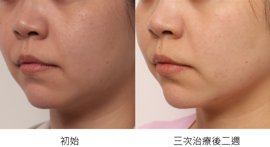 before_after