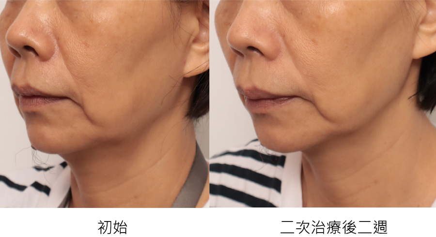 before_after